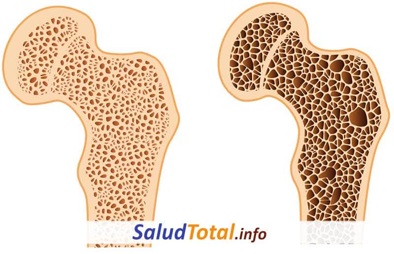 Osteoporosis Severa